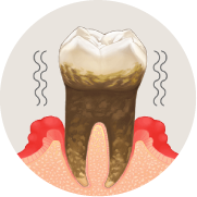 残念ながら抜歯に…