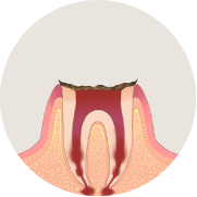 残念ながら抜歯に…