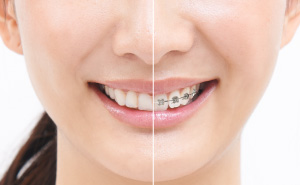大人の矯正歯科治療 | 診療案内 | あさの歯科クリニック 名東区の歯医者
